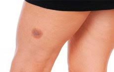 Ne spomnim se, da bi se kdaj v tem obdobju poškodovala. Lijecenje Hematoma Na Nozi Kompetentno O Zdravlju Na Ilive