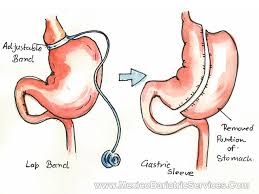 Revision Bariatric Surgery In Mexico Cost Options