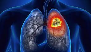 What are symptoms and signs of lung cancer? 5 Signs Of Lung Cancer That Should Not Be Ignored Lifeberrys Com