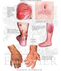 Image result for dermatitis contacta allergica
