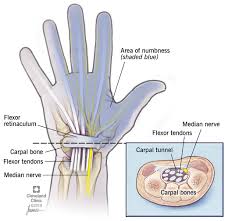 This diagram shows some common problems with the achilles tendon. Carpal Tunnel Syndrome Risk Factors Symptoms Treatment