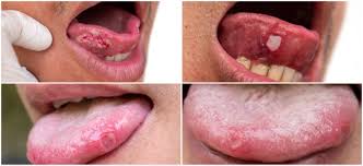 Image result for mouth ulcer on tongue)