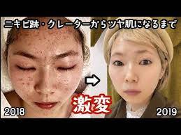 地獄の肌荒れからニキビ完治出来た方法を話します youtube ニキビ アンチエイジング 肌 メイク 肌断食