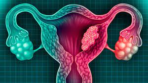Evil de utero sintomas wikipedia. Cancer De Utero Sintomas Tipos Y Edad De Mayor Riesgo