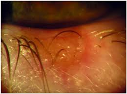 Skip to content search menu this is cancer.net's guide to eyelid cancer. Basal Cell Carcinoma Of The Eyelid In Children A Report Of Three Cases Eye