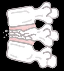 脊椎圧迫骨折のイラスト | かわいいフリー素材集 いらすとや