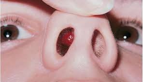 Most cases are easy to treat, but more severe infections may require additional treatment to avoid complications. Nasal Vestibulitis Pimple Inside Nose Beauty News