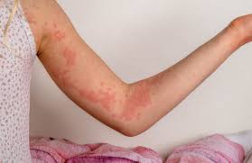 Image result for allergy rash on the legs