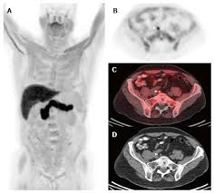 Prostate cancer is a common type of cancer in men, according to the mayo clinic. Lymph Node Imaging In Initial Staging Of Prostate Cancer An Overview And Update