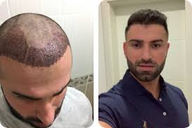 Schon die alten agypterinnen standen auf den knapp schulterlangen pagenschnitt. Haartransplantation Vorher Nachher Top Ergebnisse Elithair