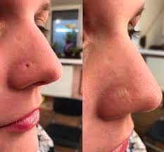 Dermaflage Is The Best Piercing Hole Concealer Because It Uses Silicone To Actually Fill In The Indentation And It Is Comp Acne Holes Scar Removal Perfect Skin