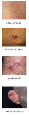 Many melanomas start as pigmented moles, but the two most common types of skin cancer, basal cells and squamous cell carcinoma, do not arise by themselves from normal skin. Melanoma And Non Melanoma Skin Cancer Cooper University Health Care