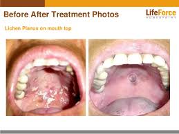 Oral Lichen Planus Photos Before And After Treatment Pictures Of Mou