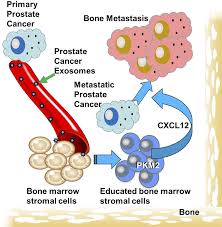 What is bone marrow cancer? Primary Prostate Cancer Educates Bone Stroma Through Exosomal Pyruvate Kinase M2 To Promote Bone Metastasis Journal Of Experimental Medicine Rockefeller University Press
