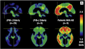 Maybe you would like to learn more about one of these? Early Detection Of Alzheimer S Disease Using Pib And Fdg Pet Sciencedirect