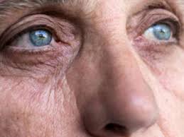 Glaucoma Types Causes And Symptoms