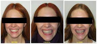 Check out the options to fix your crooked teeth. Feeling Devastated With The Sloped Smile And Crooked Jaw That Braces Gave Me What Went Wrong Braces