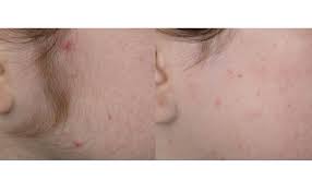 Not all laser hair removal machines are created equally, and if you find an offer that sounds too good to be true, you might be getting roped into a clinic that evaluation there are so many determining factors they play a part as to whether or not laser hair removal will work for any given individual. Laser Hair Removal Rejuvent Medical Spa Scottsdale