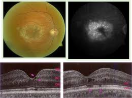An eye patch may be used in treating both! Crystalline Retinopathy Unifying Pathogenic Pathways Of Disease Sciencedirect