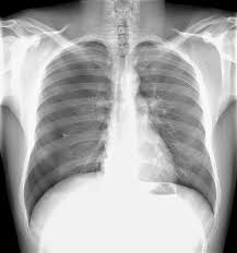 The air then fills the space outside of the lung, between the lung and chest wall. Pneumothorax X Ray Photograph By Du Cane Medical Imaging Ltd