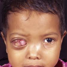 The eye should always be spared in. Primary Orbital Retinoblastoma The Right Eye Shows Proptosis With Download Scientific Diagram