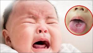 Trẻ bị cam miệng: Nguyên nhân, cách điều trị và phòng tránh