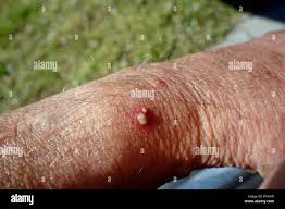 Image result for ant bite