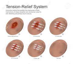 A tension headache is the most common type of headache. Tension Relief System Is An Innovative Method That Enables The Royalty Free Cliparts Vectors And Stock Illustration Image 70456932