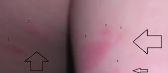 Pictures Of Bed Bug Bites On Kids Bed Bug Bites Bed Bugs Bug Bites
