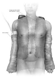 While the exact cause of pectus excavatum is unknown, it may be an inherited condition because it sometimes runs in families. References In Minimally Invasive Pectus Excavatum Repair Mirpe Operative Techniques In Thoracic And Cardiovascular Surgery