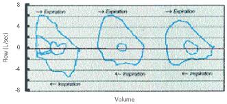 Image result for Vocal Cord Dysfunction