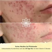 Diese gefäßerweiterungen gehen meist nicht unmittelbar wieder zurück, erklärt dr. Faces Of Fey Vitamin C Booster 20 Vitamin Kaufland De