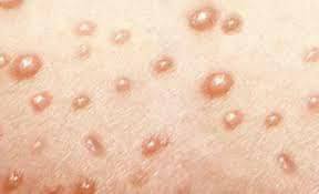 In scientific term the chickenpox is known as the varicella which is caused by the virus known as the varicella zoster which causes infection in the body and that leads to. Ilmu Kesihatan Chicken Pox Artikel 646 Drrich Drrahim 2 0 Facebook