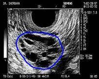 There is no cure for polycystic ovary syndrome, but there are lifestyle and medical treatments to deal with the symptoms. Diagnose Pcos Was Steckt Dahinter