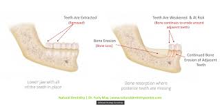 Zirconia Dental Implants Dr Yuriy May Metal Free Dental Implants