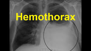 Hemothorax Symptoms Causes And Treatment Youtube