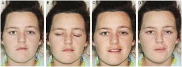 Female bell's palsy patient underwent bilateral selective neurolysis with asymmetric facelift. Bell S Palsy Syndrome Mimics And Chameleons Practical Neurology