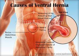 Maybe you would like to learn more about one of these? Ventral Hernia Causes Symptoms Signs Complications Diagnosis