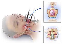 Patient With Difficult To Reach Tumor Saved Using Transoral Robotic Surgery Robotic Surgery Medical Tech Surgery