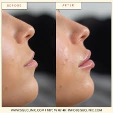 We know that when we put a filler in a place that we're moving all the time, it's likely to break down a bit faster. Lip Fillers That Don T Hurt Dublin Cork Killarney Belfast Sisu