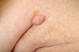 Www firstderm com wp content uploads fungal infect. Skin Infection Pictures And Treatments