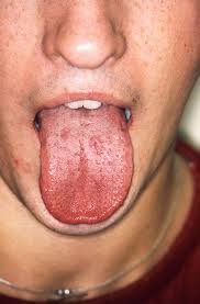 Image result for syphilis symptoms