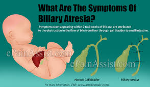 Biliary atresia only occurs in newborn infants. What Are The Symptoms Of Biliary Atresia