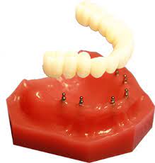 Mini Dental Implants Clermont Dental Group Dental Implants Dental Cosmetic Dentistry Teeth Implants
