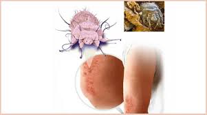 Image result for scabies norvegica