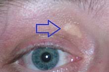Xanthelasma Wikipedia