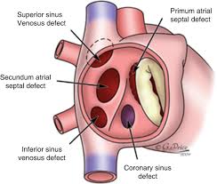 Image result for Atrial Septal Defect