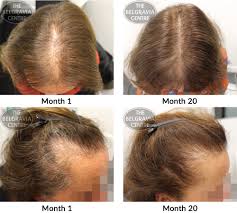 Female pattern hair loss may be triggered by low oestrogen to androgen. Hair Growth Success Much Fuller Hair No Wide Parting