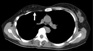 Explore symptoms, inheritance, genetics of this condition. Poland Syndrome Accompanied By Internal Iliac Artery Supply Disruption Sequence A Case Report Journal Of Medical Case Reports Full Text