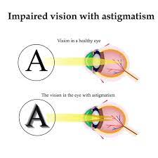 How To Naturally Improve Poor Vision Caused By Astigmatism